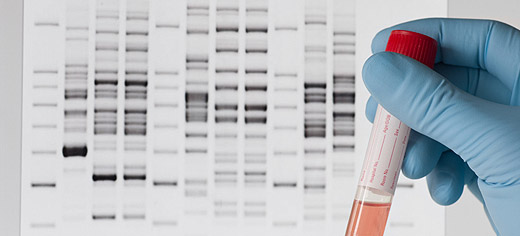 First evidence that obesity gene is risk factor for melanoma