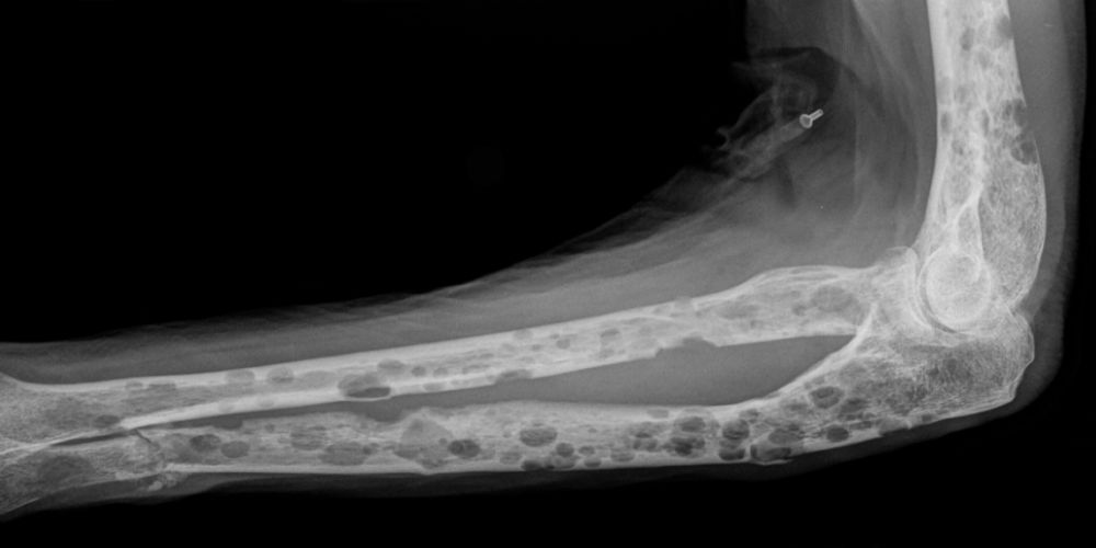 An x-ray showing lesions in a multiple myeloma patient