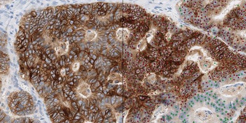 Inside the bowel showing cancerous cells