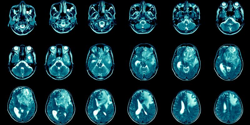 A human brain scan showing repeated images of a brain tumour