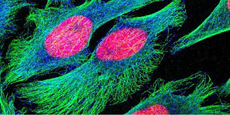 Picture shows human cancer cells which had been cultured in the laboratory