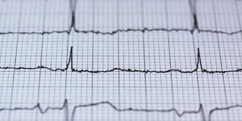 Picture shows a heart trace recorded from a patient's ECG examination