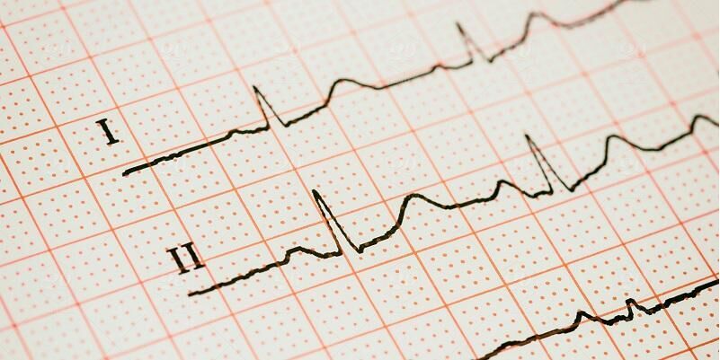 The picture shows the trace of a heartbeat taken from an ECH machine machine