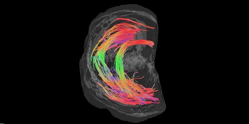 Image shows an MRI of the cervix. It reveals the encircling fibres that give it strength