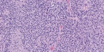 Purple image with dark spots shows brain tumour cells under the microscope