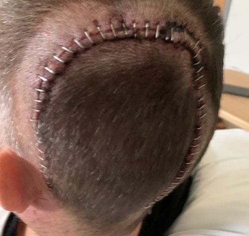 Circular scar with surgical sutures on the back of a man's head