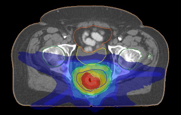 The image shows the cross section through a human body taken with a specialist radiotherapy machine.