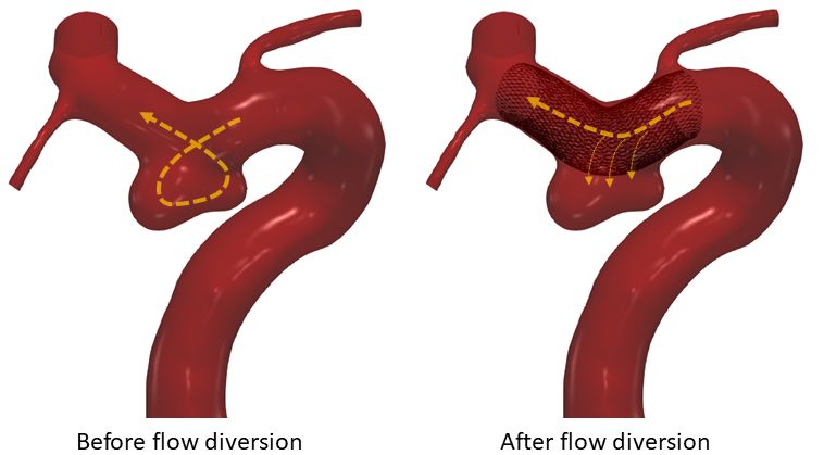 flow diversion