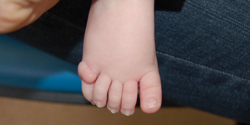 A child's foot which has an extra little toe
