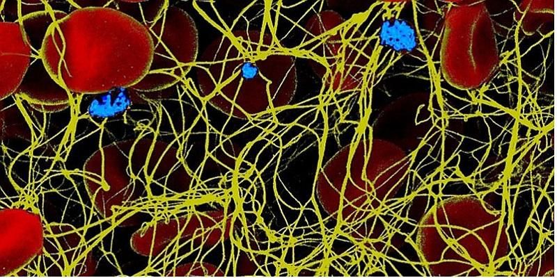 The picture shows an a blood clot seen under an electron microscope: there are coils of fibrin fibres