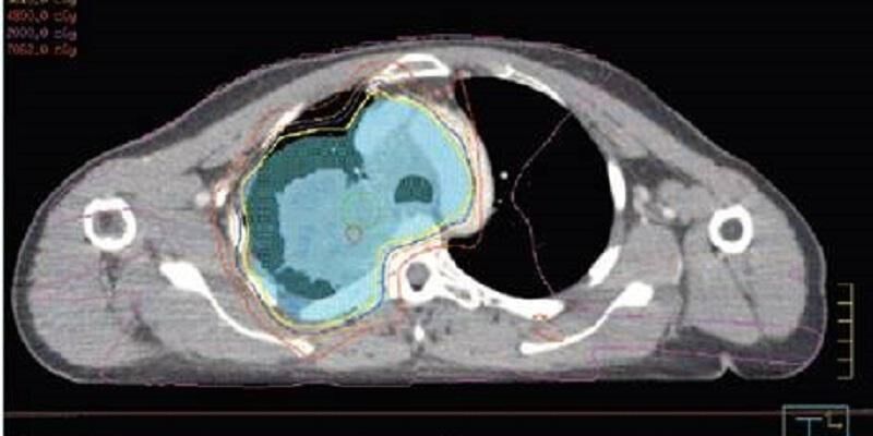 The images shows a radiotherapy image showing the cross section of a patient's chest, revealing the state of tissue in the lung cavity