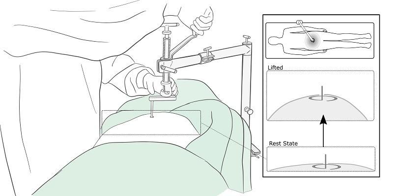Graphic showing how the RAIS device lifts the abdominal wall
