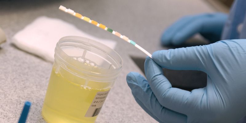 Doctors holds a urine test strip