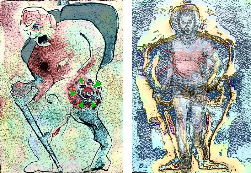 Two artworks depicting how somebody felt with a cutch and two weeks later, being able to run.