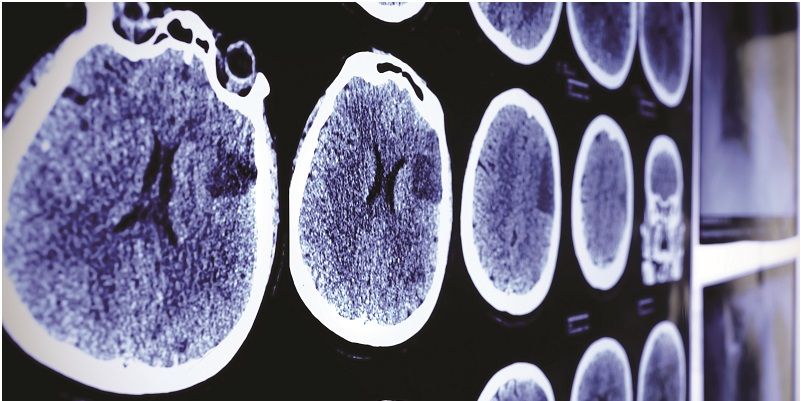 Picture shows a series of brain scan images on a visual display