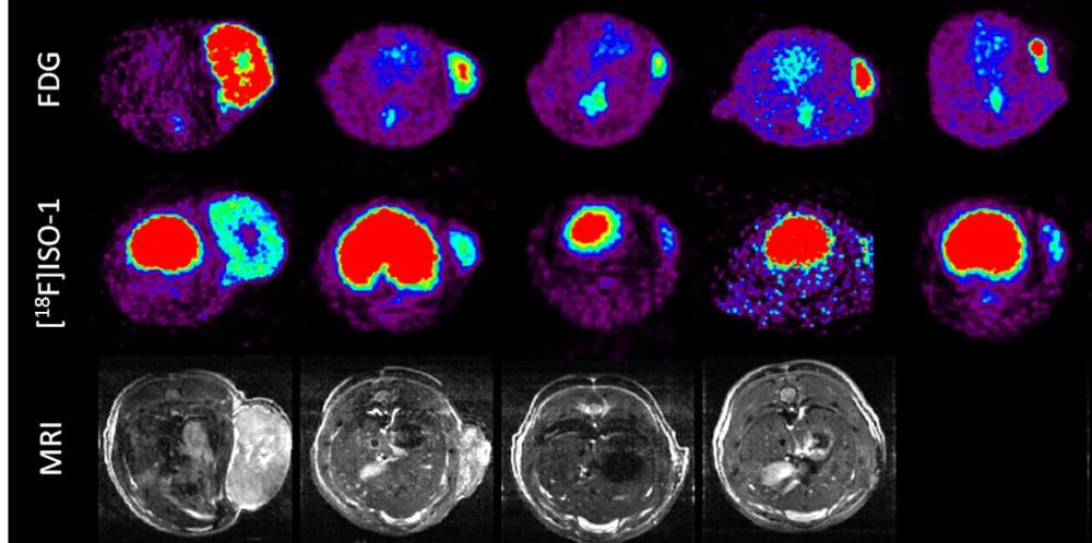 Positron emission tomography (PET) scans of a brain tumour