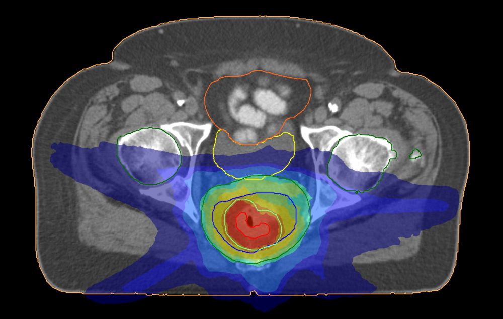 The image shows the cross section through a human body taken with a specialist radiotherapy machine.
