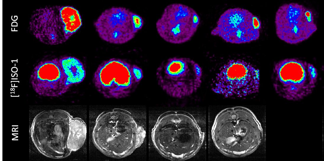 PET scans of a brain tumour