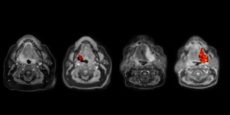 Two sets of MRI scans of a brain, with the scan on the right hand side of eat set having the oxygen-starved tumour highlighted