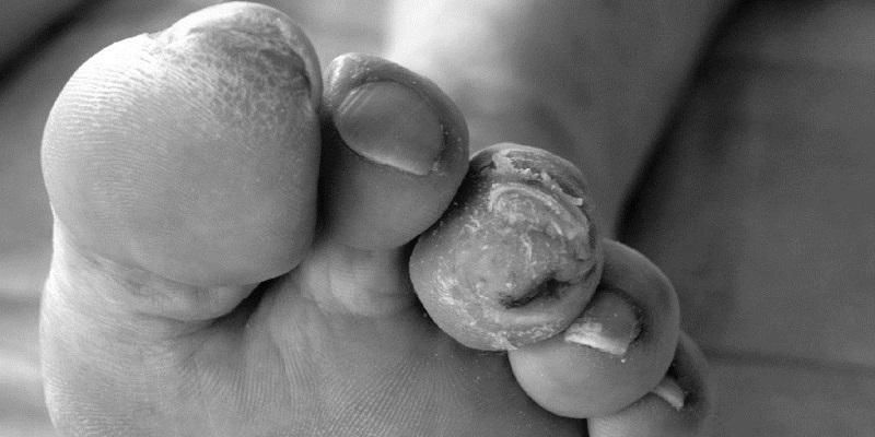 Image shows a foot of someone suffering diabetes and showing ulceration.