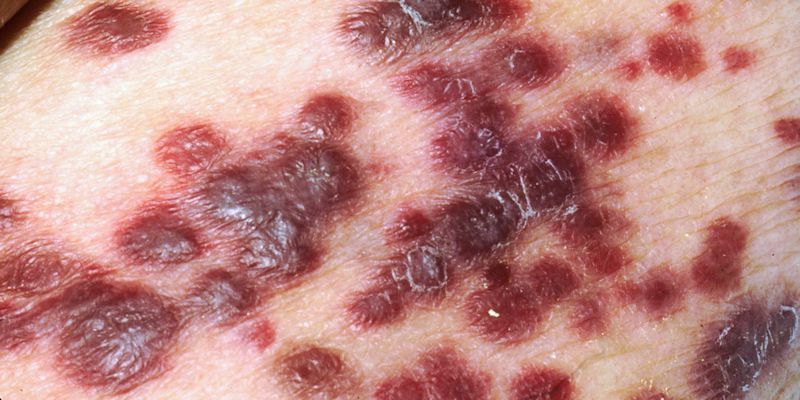 Red blotchy skin cancer