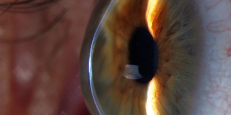A close-up image of a keratoconus patient's cornea