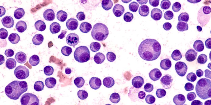 malignant myeloma plasma cells as viewed through a microscope.