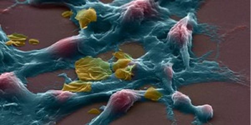 Image shows an electron microscope picture of a brain cancer cell